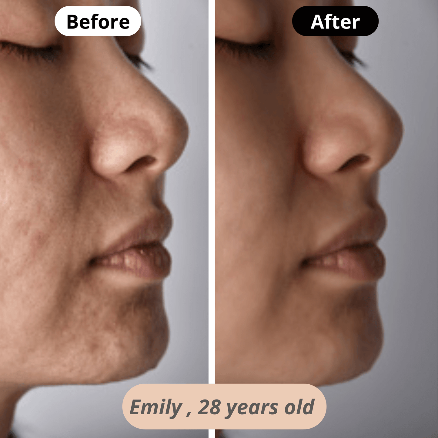 Restored natural glow – Emily (28) enjoys softer, brighter, and more even skin after regular use of our skincare device.