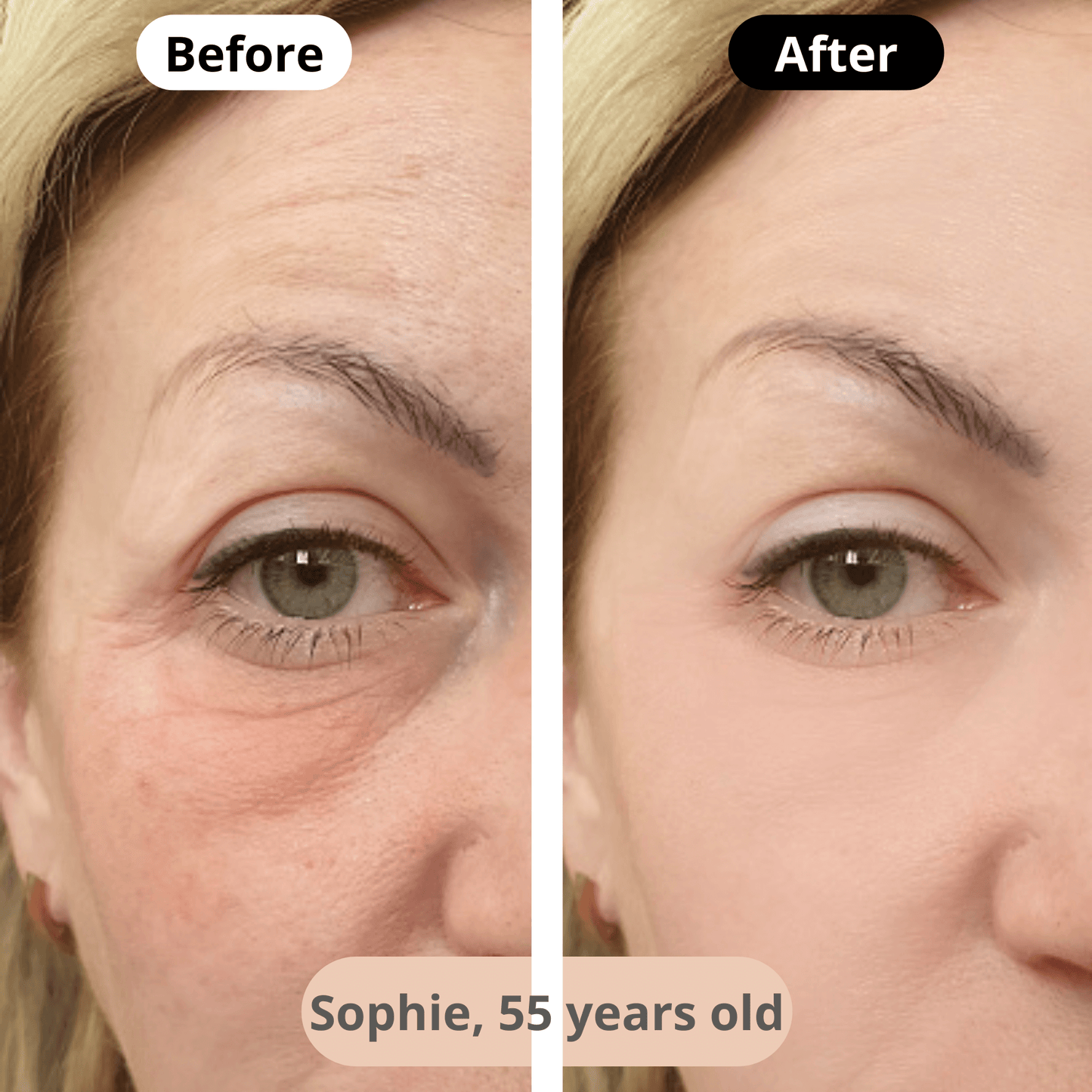 Visible wrinkle reduction – After a few weeks of using the facial massager, Sophie (58) enjoys smoother skin and a rejuvenated look.