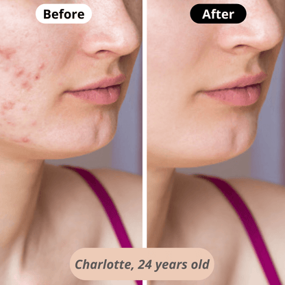 Clearer and more radiant skin – Charlotte (24) sees reduced blemishes and a more even complexion thanks to our LED therapy facial massager.
