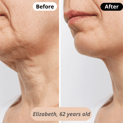  Firmer, lifted skin – Elizabeth (62) experiences a noticeable improvement in skin elasticity, with a firmer and more defined neck.