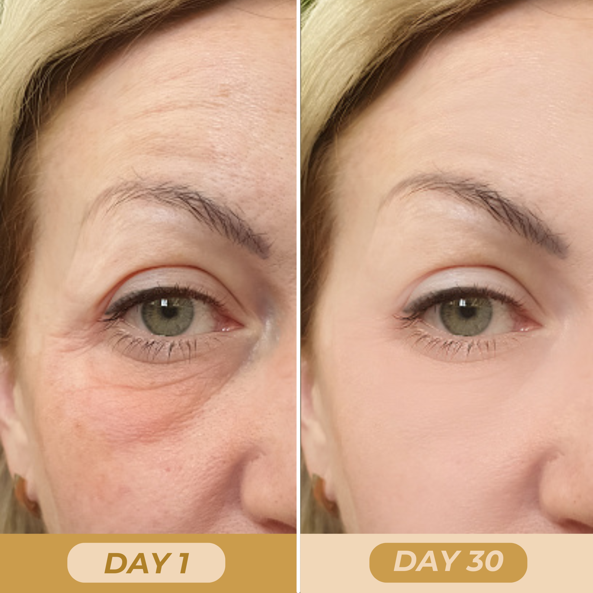 Photo 3 (Day 1 – Dark circles): Presence of wrinkles, fine lines, and skin laxity around the eyes.
Photo 4 (Day 30 – Rejuvenated under-eye area): Smoother skin, reduced fine lines, and a fresher look.