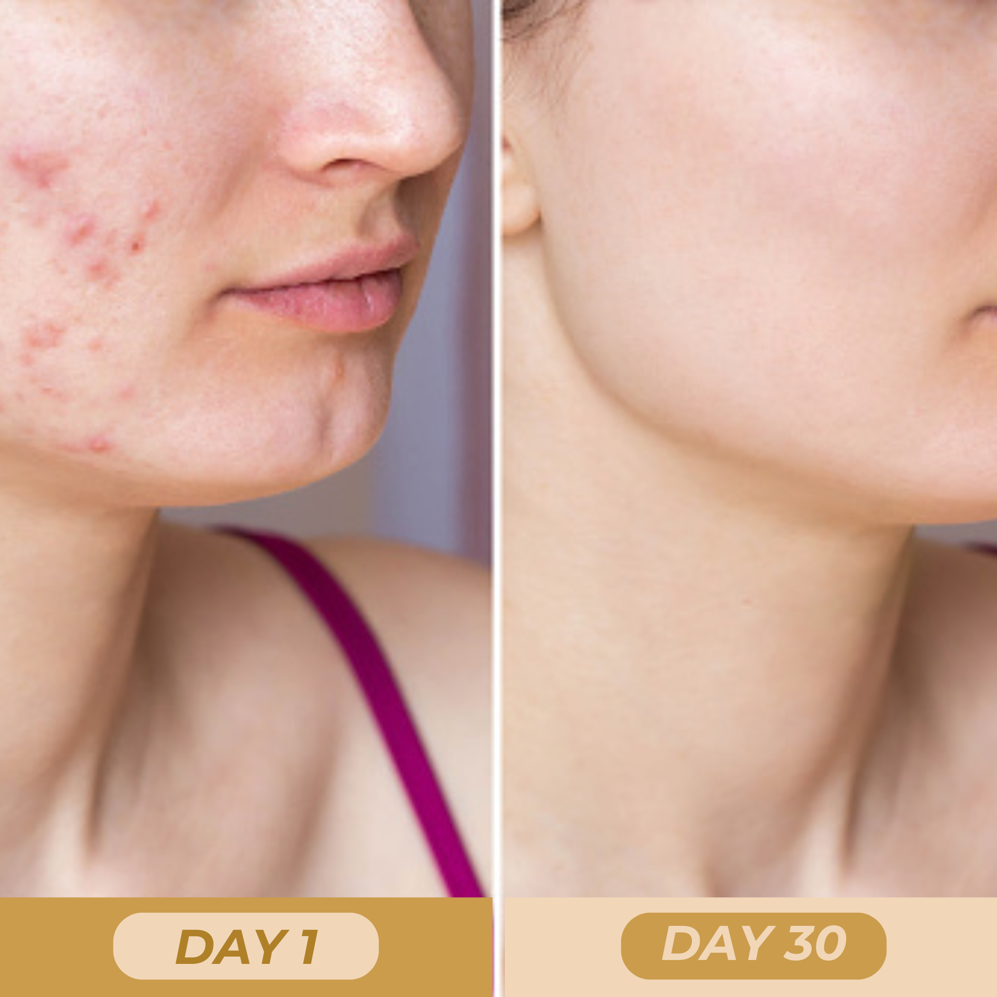 Photo 5 (Day 1 – Acne-prone skin): Redness, blemishes, and uneven skin texture.
Photo 6 (Day 30 – Clear and glowing skin): More even complexion, reduced redness, and visibly healthier skin.