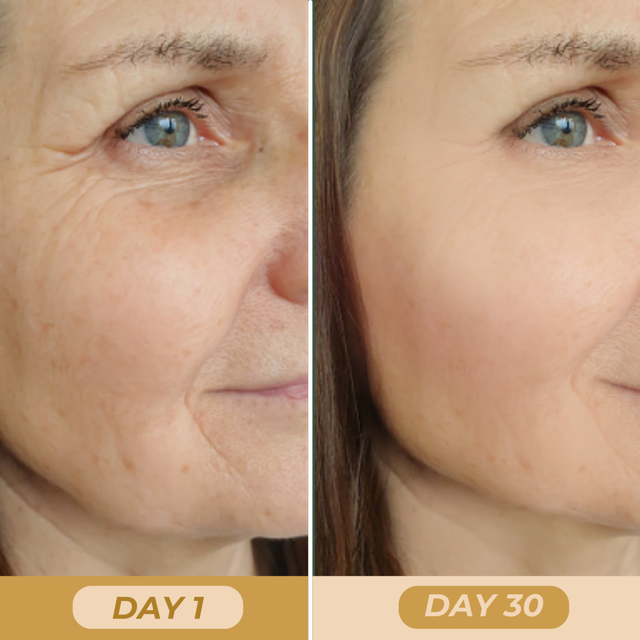 Photo 7 (Day 1 – Crow’s Feet): Skin marked by deep wrinkles and sagging.
Photo 8 (Day 30 – Crow’s Feet): After 30 days of using the facial massager: firmer skin and reduced wrinkles.