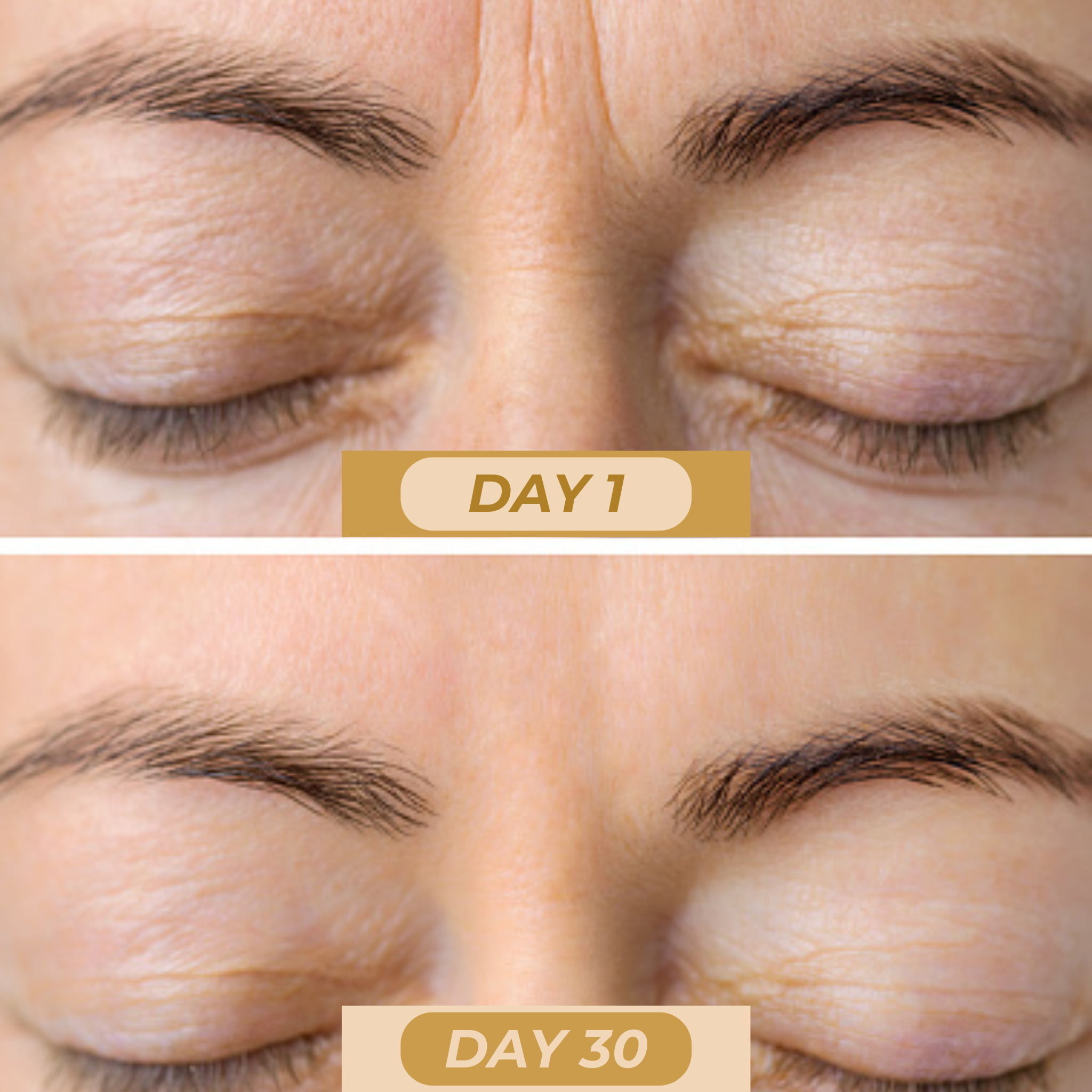 Photo 9 (Day 1 – Frown Lines): Wrinkled eyelids and visible fine lines.
Photo 10 (Day 30 – Frown Lines): After one month of facial massage: significant reduction of the frown line, firmer eyelids, and toned skin